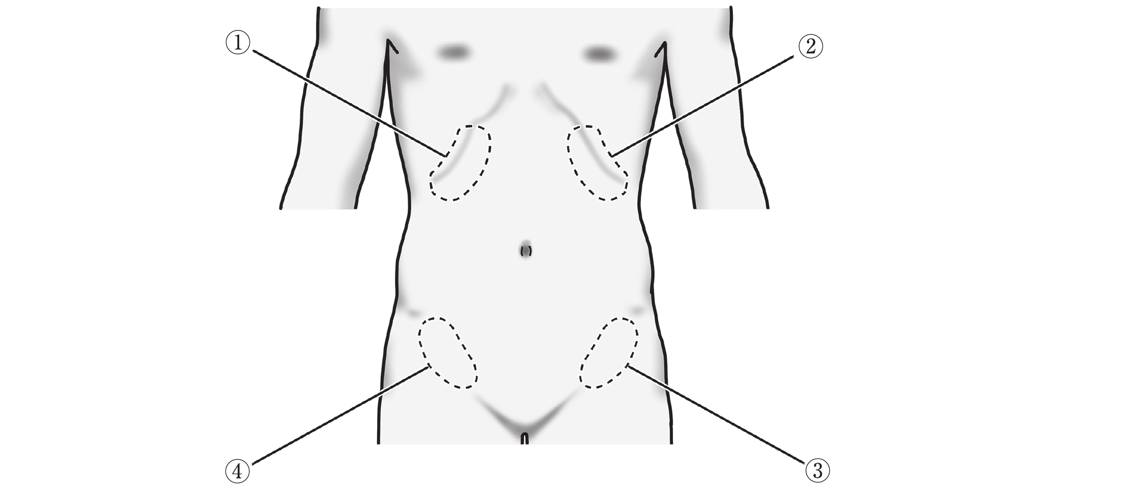腹部の図。腹痛の部位の候補が①〜④で示されている